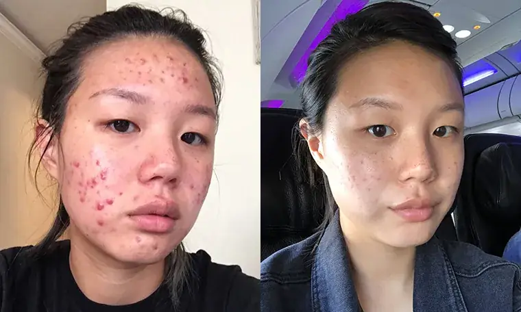 How YouTuber Hana Lee Kicked Her Acne to the Curb and What She Learned on Her Journey to Clear Skin Illustrations