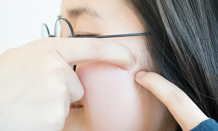 How to Prevent Scarring After You’ve Popped a Pimple Illustrations