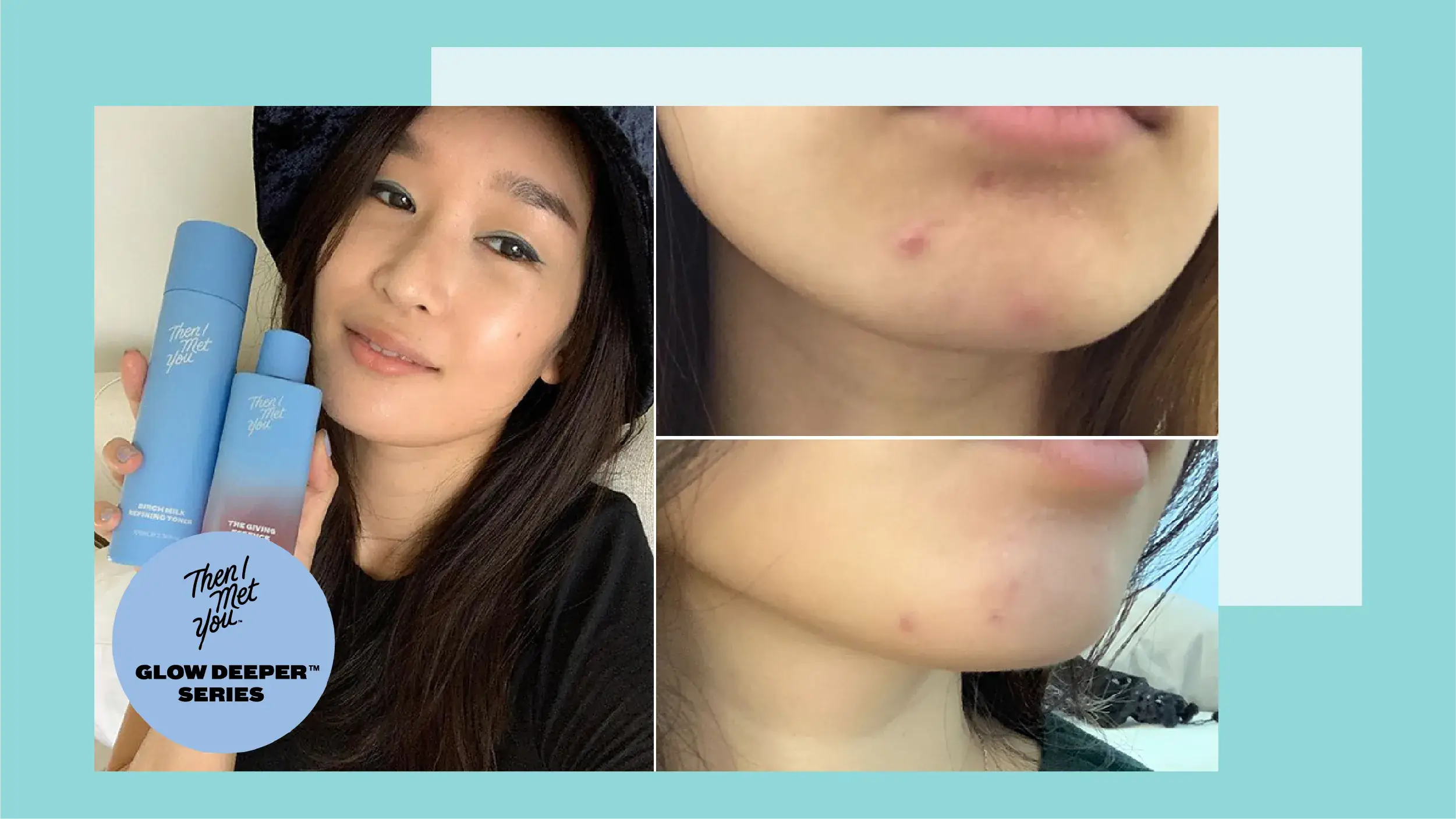 Glow Deeper™ Series: The Two Products That Finally Helped Me Get Rid of My Persistent Hormonal Acne Illustrations