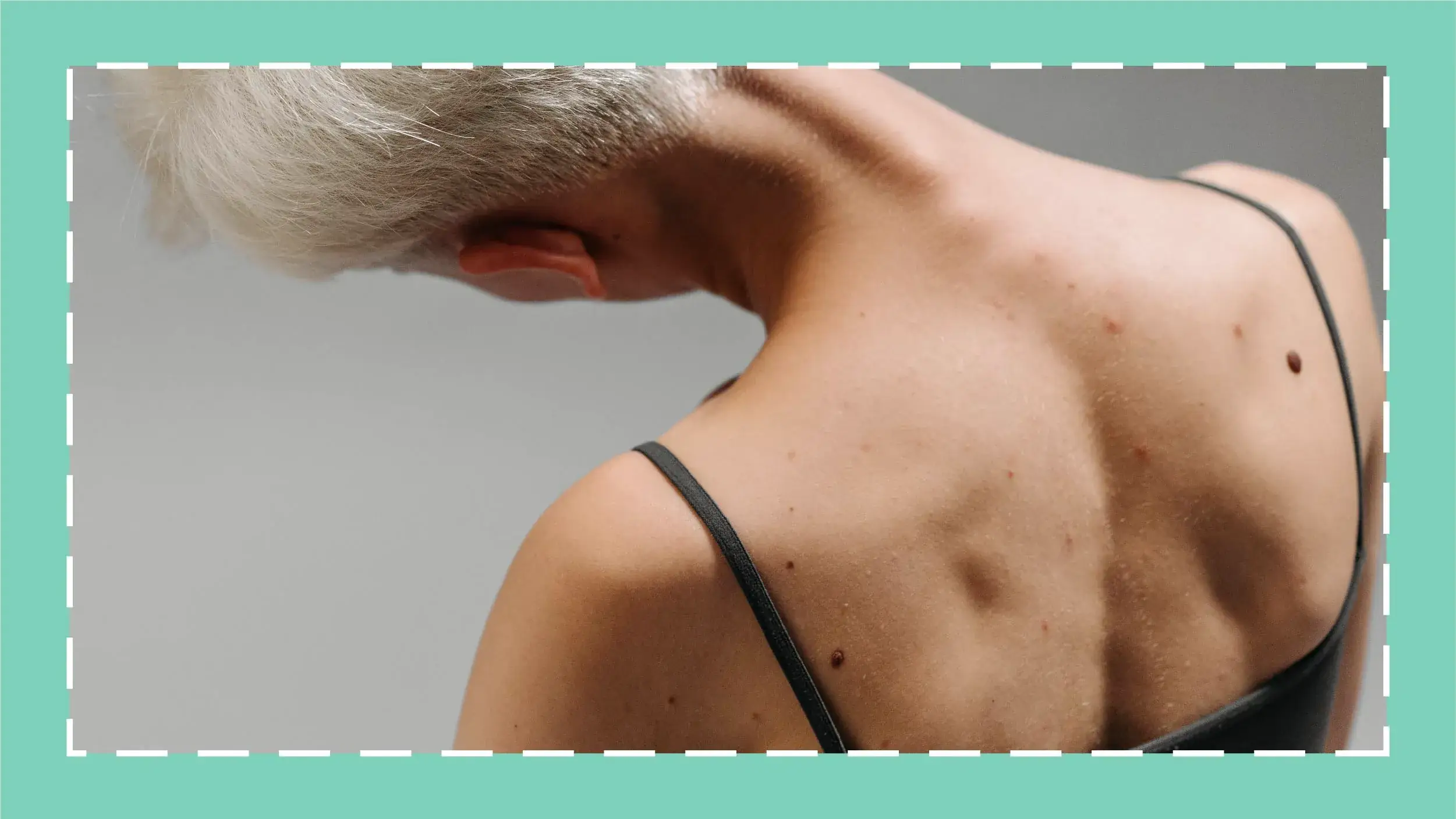 Here’s How Body Hyperpigmentation Differs From Facial Hyperpigmentation 그림